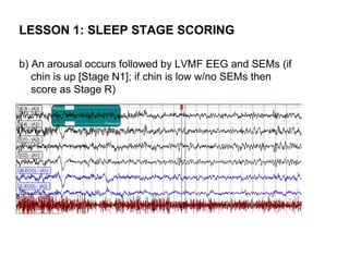 LESSON 1: SLEEP STAGE SCORING

b) An arousal occurs followed by LVMF EEG and SEMs (if
   chin is up [Stage N1]; if chin is low w/no SEMs then
   score as Stage R)
 