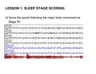 LESSON 1: SLEEP STAGE SCORING

d) Score the epoch following the major body movement as
   Stage N1
 