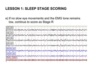 LESSON 1: SLEEP STAGE SCORING

e) If no slow eye movements and the EMG tone remains
   low, continue to score as Stage R
 