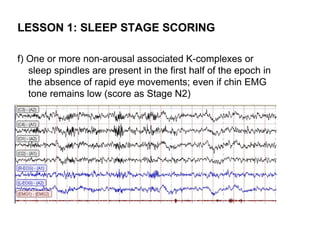 LESSON 1: SLEEP STAGE SCORING

f) One or more non-arousal associated K-complexes or
   sleep spindles are present in the first half of the epoch in
   the absence of rapid eye movements; even if chin EMG
   tone remains low (score as Stage N2)
 