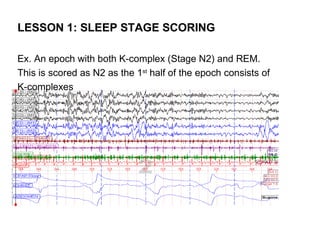 LESSON 1: SLEEP STAGE SCORING

Ex. An epoch with both K-complex (Stage N2) and REM.
This is scored as N2 as the 1st half of the epoch consists of
K-complexes
 