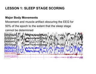 LESSON 1: SLEEP STAGE SCORING

Major Body Movements
Movement and muscle artifact obscuring the EEG for
50% of the epoch to the extent that the sleep stage
cannot be determined
 
