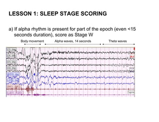 LESSON 1: SLEEP STAGE SCORING

a) If alpha rhythm is present for part of the epoch (even <15
   seconds duration), score as Stage W
     Body movement    Alpha waves, 14 seconds   Theta waves
 