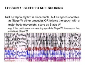 LESSON 1: SLEEP STAGE SCORING

b) If no alpha rhythm is discernable, but an epoch scorable
   as Stage W either precedes OR follows the epoch with a
   major body movement, score as Stage W
  e.g. If the previous or succeeding epoch is Stage W, then score this
  epoch as Stage W
 