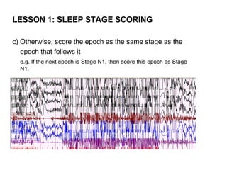 LESSON 1: SLEEP STAGE SCORING

c) Otherwise, score the epoch as the same stage as the
   epoch that follows it
  e.g. If the next epoch is Stage N1, then score this epoch as Stage
  N1.
 