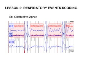 LESSON 2: RESPIRATORY EVENTS SCORING

  Ex. Obstructive Apnea
 