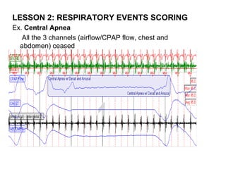 LESSON 2: RESPIRATORY EVENTS SCORING
Ex. Central Apnea
   All the 3 channels (airflow/CPAP flow, chest and
  abdomen) ceased
 