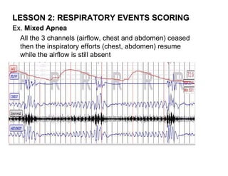 LESSON 2: RESPIRATORY EVENTS SCORING
Ex. Mixed Apnea
  All the 3 channels (airflow, chest and abdomen) ceased
  then the inspiratory efforts (chest, abdomen) resume
  while the airflow is still absent
 