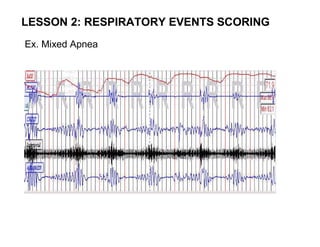 LESSON 2: RESPIRATORY EVENTS SCORING
Ex. Mixed Apnea
 