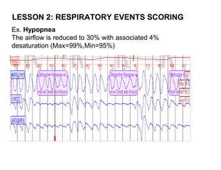 LESSON 2: RESPIRATORY EVENTS SCORING
Ex. Hypopnea
The airflow is reduced to 30% with associated 4%
desaturation (Max=99%,Min=95%)
 