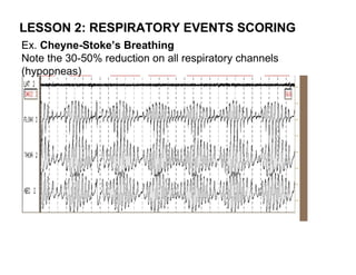 LESSON 2: RESPIRATORY EVENTS SCORING
Ex. Cheyne-Stoke’s Breathing
Note the 30-50% reduction on all respiratory channels
(hypopneas)
 