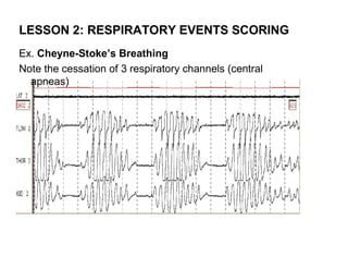 LESSON 2: RESPIRATORY EVENTS SCORING
Ex. Cheyne-Stoke’s Breathing
Note the cessation of 3 respiratory channels (central
  apneas)
 