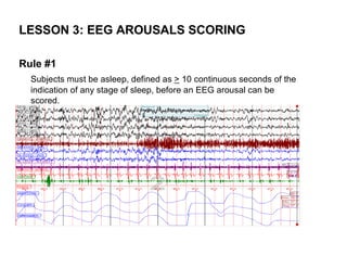 LESSON 3: EEG AROUSALS SCORING

Rule #1
  Subjects must be asleep, defined as > 10 continuous seconds of the
  indication of any stage of sleep, before an EEG arousal can be
  scored.
 