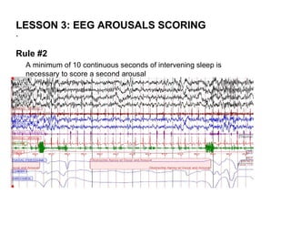 LESSON 3: EEG AROUSALS SCORING
.

Rule #2
    A minimum of 10 continuous seconds of intervening sleep is
    necessary to score a second arousal
 