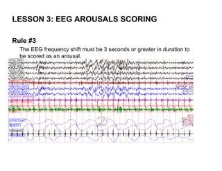 LESSON 3: EEG AROUSALS SCORING

Rule #3
  The EEG frequency shift must be 3 seconds or greater in duration to
  be scored as an arousal.
 