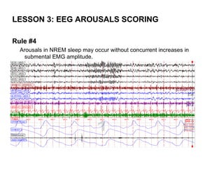 LESSON 3: EEG AROUSALS SCORING

Rule #4
  Arousals in NREM sleep may occur without concurrent increases in
   submental EMG amplitude.
 