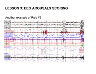 LESSON 3: EEG AROUSALS SCORING

Another example of Rule #5
 