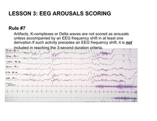 LESSON 3: EEG AROUSALS SCORING

Rule #7
  Artifacts, K-complexes or Delta waves are not scored as arousals
  unless accompanied by an EEG frequency shift in at least one
  derivation.If such activity precedes an EEG frequency shift, it is not
  included in reaching the 3-second duration criteria.
 
