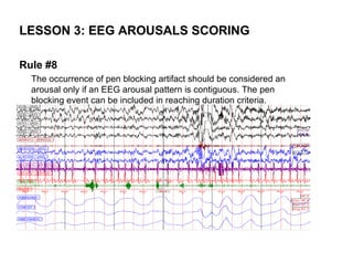 LESSON 3: EEG AROUSALS SCORING

Rule #8
  The occurrence of pen blocking artifact should be considered an
  arousal only if an EEG arousal pattern is contiguous. The pen
  blocking event can be included in reaching duration criteria.
 
