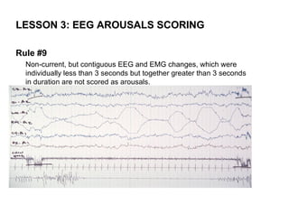 LESSON 3: EEG AROUSALS SCORING

Rule #9
  Non-current, but contiguous EEG and EMG changes, which were
  individually less than 3 seconds but together greater than 3 seconds
  in duration are not scored as arousals.
 