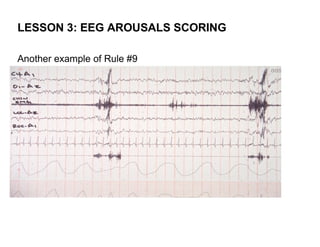 LESSON 3: EEG AROUSALS SCORING

Another example of Rule #9
 