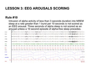 LESSON 3: EEG AROUSALS SCORING

Rule #10
  Intrusion of alpha activity of less than 3 seconds duration into NREM
  sleep at a rate greater than 1 burst per 10 seconds is not scored as
  an EEG arousal. Three seconds of alpha sleep is not scored as an
  arousal unless a 10 second episode of alpha-free sleep precedes.
 