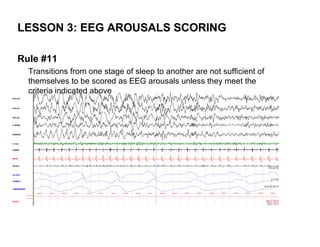 LESSON 3: EEG AROUSALS SCORING

Rule #11
  Transitions from one stage of sleep to another are not sufficient of
  themselves to be scored as EEG arousals unless they meet the
  criteria indicated above
 