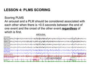 LESSON 4: PLMS SCORING

Scoring PLMS
An arousal and a PLM should be considered associated with
each other when there is <0.5 seconds between the end of
one event and the onset of the other event regardless of
which is first.
                      AROUSAL




                                LEG MOVEMENT
 