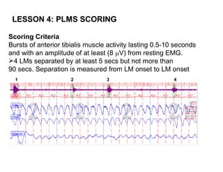 LESSON 4: PLMS SCORING

Scoring Criteria
Bursts of anterior tibialis muscle activity lasting 0.5-10 seconds
and with an amplitude of at least (8 V) from resting EMG.
4 LMs separated by at least 5 secs but not more than
90 secs. Separation is measured from LM onset to LM onset
  1                  2            3                       4
 