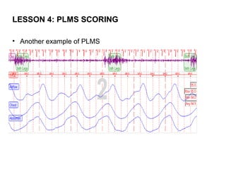 LESSON 4: PLMS SCORING

• Another example of PLMS
 