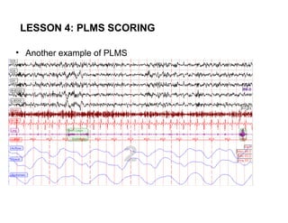 LESSON 4: PLMS SCORING

• Another example of PLMS
 