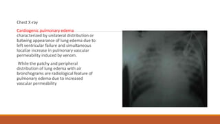 Chest X-ray
Cardiogenic pulmonary edema
characterized by unilateral distribution or
batwing appearance of lung edema due to
left ventricular failure and simultaneous
localize increase in pulmonary vascular
permeability induced by venom.
While the patchy and peripheral
distribution of lung edema with air
bronchograms are radiological feature of
pulmonary edema due to increased
vascular permeability
 