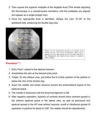 2. Then square the superior endplate of the targeted level (This entails adjusting
the fluoroscope in a cranial/caudal orientation until the endplates are aligned
and appear as a single straight line).
3. Once the appropriate level is identified, oblique the view 15–30° to the
ipsilateral side, producing the Scottie dog view.
Procedure3,4,5
:
1. Entry Point: Lateral to the desired foramen.
2. Anesthetize the skin at the desired entry point.
3. Target: On the oblique view, just below the 6 o’clock position of the pedicle or
below the chin of the Scottie dog
4. Insert the needle and slowly advance toward the antero/lateral aspect of the
epidural space.
5. The needle is advanced until the foraminal ligament is felt.
6. After negative aspiration, injection of contrast should show contrast spread in
the anterior epidural space in the lateral view, as well as perineural and
epidural spread in the AP view without vascular runoff or intrathecal spread (If
aspiration is positive for blood or CSF, the needle should be repositioned).
Oblique view for transforaminal approach to an epidural steroid
injection at L4–L5. The L4 nerve is identified as yellow color. It
appears from the region below the chin of Scottie dog (from:
Pain Management and Palliative Care, Kimberly A. Sackheim
Editor, Springer)
 