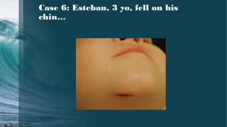 Case 6: Esteban, 3 yo, fell on his
chin…
 