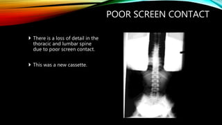 POOR SCREEN CONTACT
 There is a loss of detail in the
thoracic and lumbar spine
due to poor screen contact.
 This was a new cassette.
 