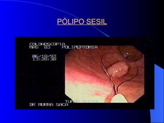 PÓLIPO SESIL 