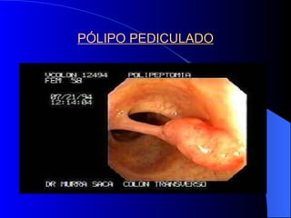 PÓLIPO PEDICULADO 