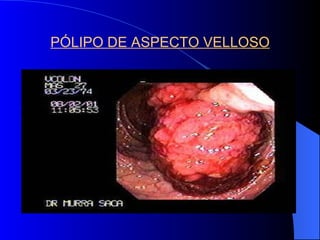 PÓLIPO DE ASPECTO VELLOSO 