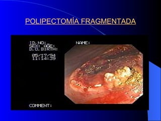 POLIPECTOMÍA FRAGMENTADA 