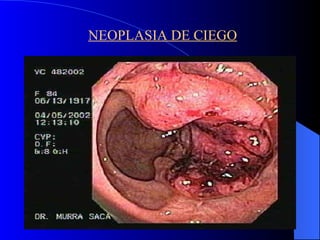 NEOPLASIA DE CIEGO 