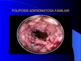POLIPOSIS ADENOMATOSA FAMILIAR 