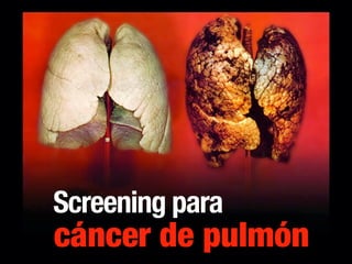 Screening para
cáncer de pulmón
 