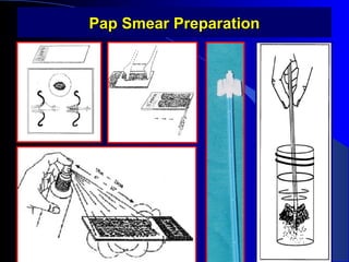 Pap Smear PreparationPap Smear Preparation
 