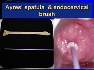 Ayres’ spatula & endocervicalAyres’ spatula & endocervical
brushbrush
 