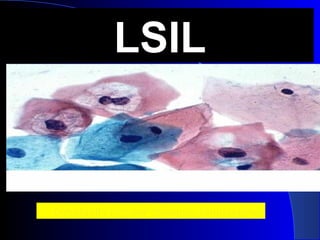 LSILLSIL
Dysplastic nuclear changes, binucleationDysplastic nuclear changes, binucleation
 