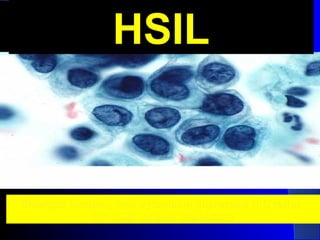 HSILHSIL
Enlarged nucleus, less cytoplasm (increased N:C ratio).Enlarged nucleus, less cytoplasm (increased N:C ratio).
Irregular nuclear membraneIrregular nuclear membrane
 
