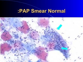 PAP Smear NormalPAP Smear Normal::
 
