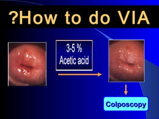 ``
ColposcopyColposcopy
How to do VIAHow to do VIA??
 