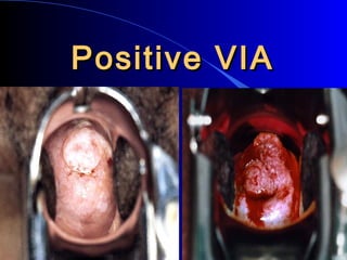 Positive VIAPositive VIA
 