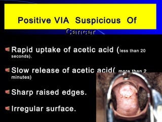 Positive VIA Suspicious OfPositive VIA Suspicious Of
CancerCancer
Rapid uptake of acetic acid (Rapid uptake of acetic acid (less than 20less than 20
seconds).seconds).
Slow release of acetic acid(Slow release of acetic acid( more than 2more than 2
minutes)minutes)
Sharp raised edges.Sharp raised edges.
Irregular surface.Irregular surface.
 